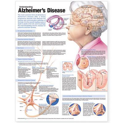 Understanding Alzheimers Disease Anatomical Chart - att frst Alzheimer affisch 50x65cm papper