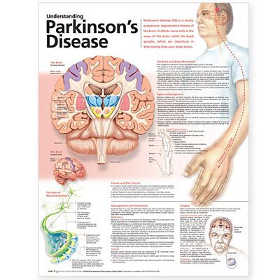 Understanding Parkinsons Disease Anatomical Chart - att frst Parkinsson affisch 50x65cm laminerad
