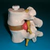 Anatomisk modell lumbar vertebral kotor med diskbrck