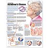 Understanding Alzheimers Disease Anatomical Chart - att frst Alzheimer affisch 50x65cm laminerad